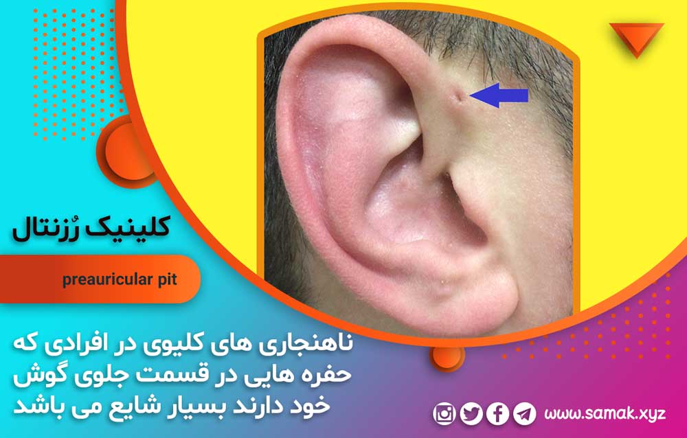 بیماری کلیه و کم شنوایی : ارتباط بین حفره جلو گوش با اختلال کلیوی