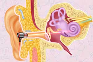 درمان وزوز گوش با لیزر